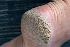 Painful heel fissure detail